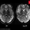 L'IRM Iseult, la plus puissante du monde (11,7 teslas) pour percer les mystères du cerveau