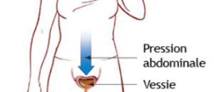 L'incontinence urinaire d'effort chez les seniors