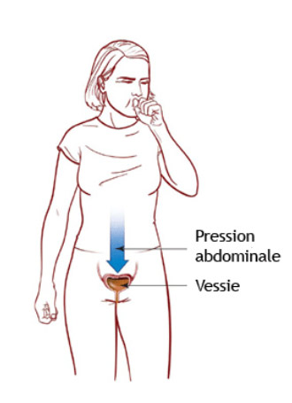 Comprendre l'incontinence urinaire masculine : causes et solution