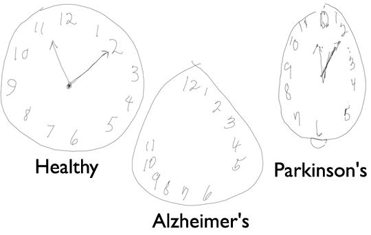Guide des maisons de retraite : Un stylo connecté et des horloges pour  détecter en amont la maladie d'Alzheimer